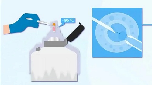 做第一代試管嬰兒的技術優勢